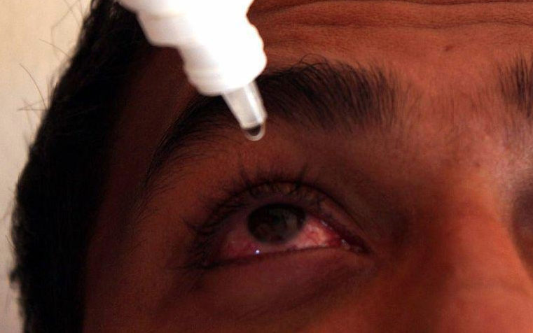 Brote de conjuntivitis empeora en el estado
