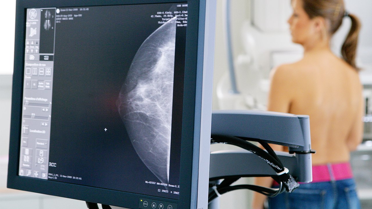 Diagnostico cancer de mama 1
