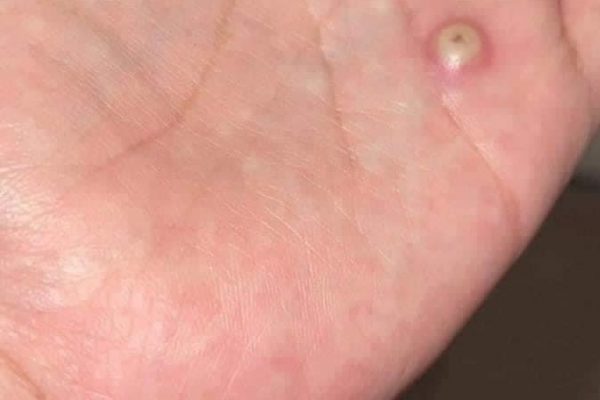 Ya son seis casos de viruela del mono en Yucatán