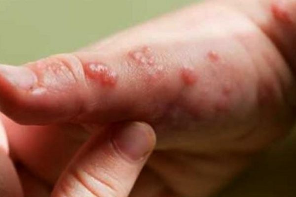 Viruela Símica no es tan contagiosa: SSY